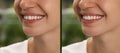 Collage with photos of woman with diastema between upper front teeth before and after treatment on blurred background