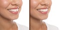 Collage with photos of woman with diastema between upper front teeth before and after treatment on white background, closeup.