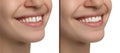 Collage with photos of woman with diastema between upper front teeth before and after treatment on white background, closeup.