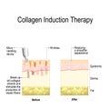 Collagen induction therapy microneedling Royalty Free Stock Photo