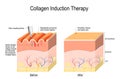 Collagen induction therapy. microneedling the skin Royalty Free Stock Photo