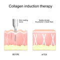 Collagen induction therapy Royalty Free Stock Photo