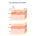 Collagen induction therapy. microneedling the skin