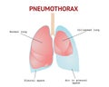 Collapsed lung or Pneumothorax, lungs disease, isolated vector illustration on White background