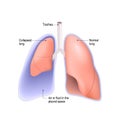 Collapsed lung. pneumothorax, or pleural effusion, Royalty Free Stock Photo