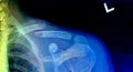 Collar bone X-Ray Royalty Free Stock Photo