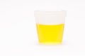 Collection bottle with urine, urinalysis EAS - Abnormal Sediment Elements, serves to analyze the pH of urine such as: Nitrites,
