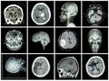 Collection of brain disease