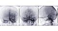 Collection of Cerebral angiography image. Royalty Free Stock Photo