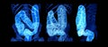 Collection of CT colonography or CT Scan of Colon 3D Rendering image showing colon for screening colorectal cancer.