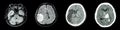 Collection CT scan of brain and multiple disease