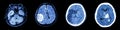 Collection CT scan of brain and multiple disease