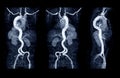 Collection of CTA whoe aorta with curve MPR technique