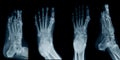 Collection foot x-ray Royalty Free Stock Photo