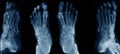 Collection foot x-ray Royalty Free Stock Photo