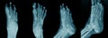 Collection foot x-ray image in blue tone Royalty Free Stock Photo