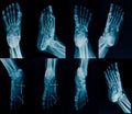 Collection foot x-ray Royalty Free Stock Photo