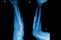 Collection of human x-rays showing fracture of radius bone