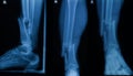 Collection of human x-rays showing fracture of right leg