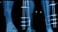 Collection of human x-rays showing fracture of right leg