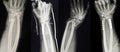 Collection of human x-rays showing Multiple hand fracture. Royalty Free Stock Photo