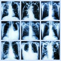 Collection of lung disease (Pulmonary tuberculosis,Pleural effusion,Bronchiectasis)