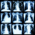 Collection of lung disease (Pulmonary tuberculosis,Pleural effusion,Bronchiectasis)