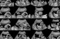 Collection of ultrasonography fetus scans