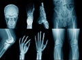 Collection x-ray image Royalty Free Stock Photo