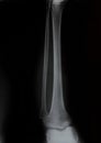 Collection of x-ray leg and knee Royalty Free Stock Photo