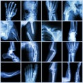 Collection X-ray multiple bone fracture Royalty Free Stock Photo