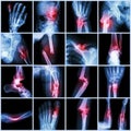 Collection X-ray multiple bone fracture Royalty Free Stock Photo