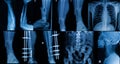 Collection of X-ray , Multiple part of adult show fracture bon Royalty Free Stock Photo