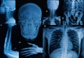 Collection of X-ray , Multiple part of adult show fracture bon Royalty Free Stock Photo