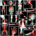 Collection of X-ray multiple part of human,Orthopedic operation and multiple disease (Shoulder Royalty Free Stock Photo