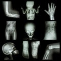 Collection X-ray part of child Royalty Free Stock Photo