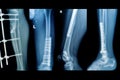 Collection x-rays image of fracture lower extremity Royalty Free Stock Photo