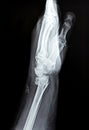 Colles' fracture of an old female, a type of fracture of the distal forearm in which the broken end of the radius is bent