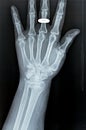 Colles' fracture of an old female, a type of fracture of the distal forearm in which the broken end of the radius is bent