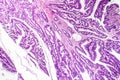 Colon adenocarcinoma, cancer of colon Royalty Free Stock Photo