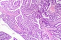Colon adenocarcinoma, cancer of colon Royalty Free Stock Photo