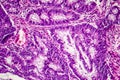 Colon adenocarcinoma, cancer of colon