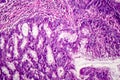 Colon adenocarcinoma, cancer of colon