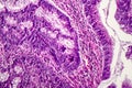 Colon adenocarcinoma, cancer of colon Royalty Free Stock Photo
