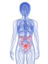 Colon cancer