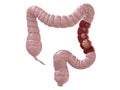 Colon cancer