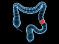Colon cancer Royalty Free Stock Photo
