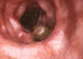 Colon cancer closeup - 3D Rendering Royalty Free Stock Photo