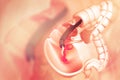 Colon cancer. colonoscope in the colon