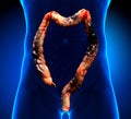 Colon Cancer / Colorectal cancer Royalty Free Stock Photo
